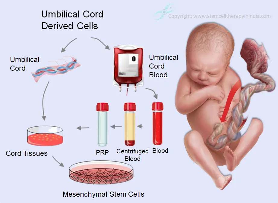 umbilical cord derived cells